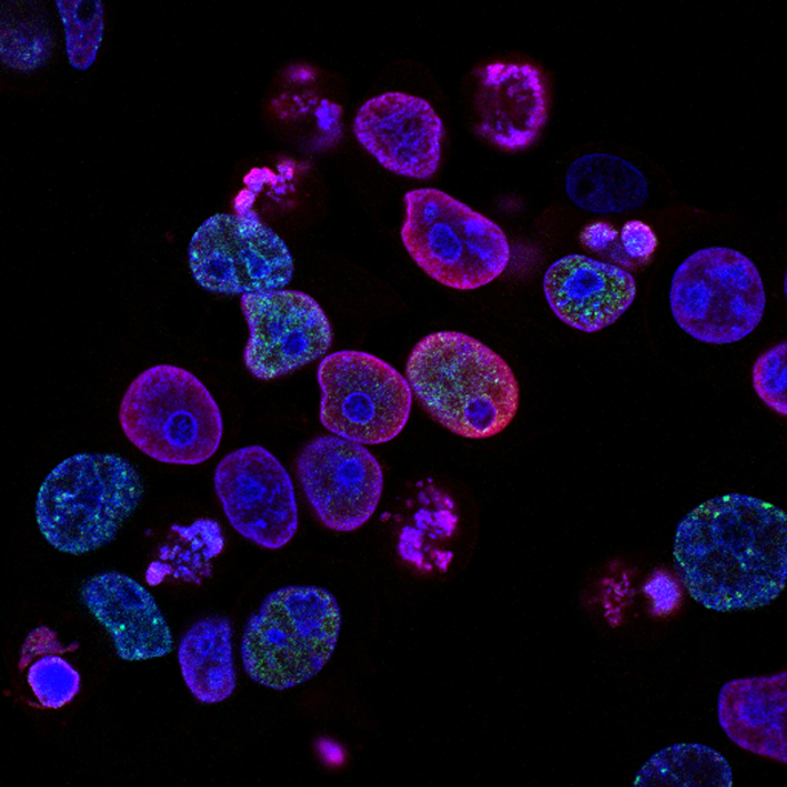 Imagen de microscopio de células cancerosas